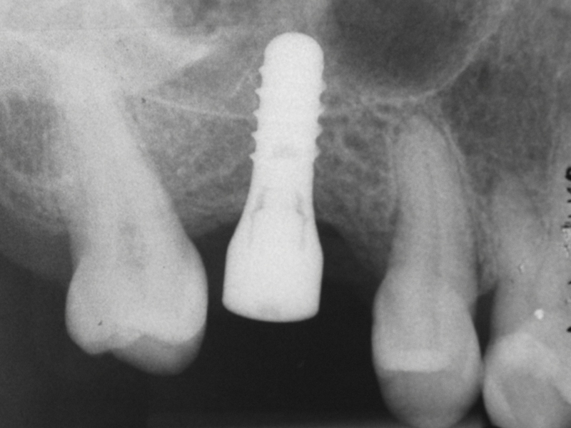 2 Implantat im Oberkiefer mit Knochenaufbau (Sinuslift)